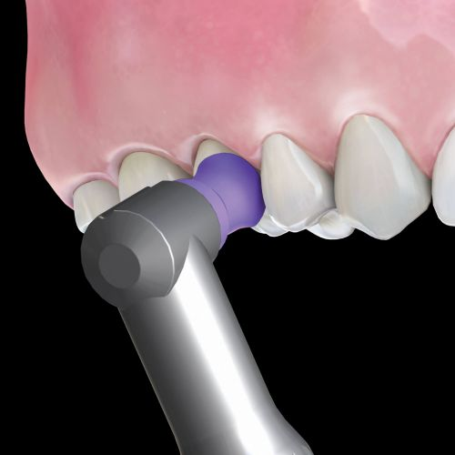 Hu-Friedy Prophy Angle Soft Purple Latex-Free 100/Bx thumbnail 17