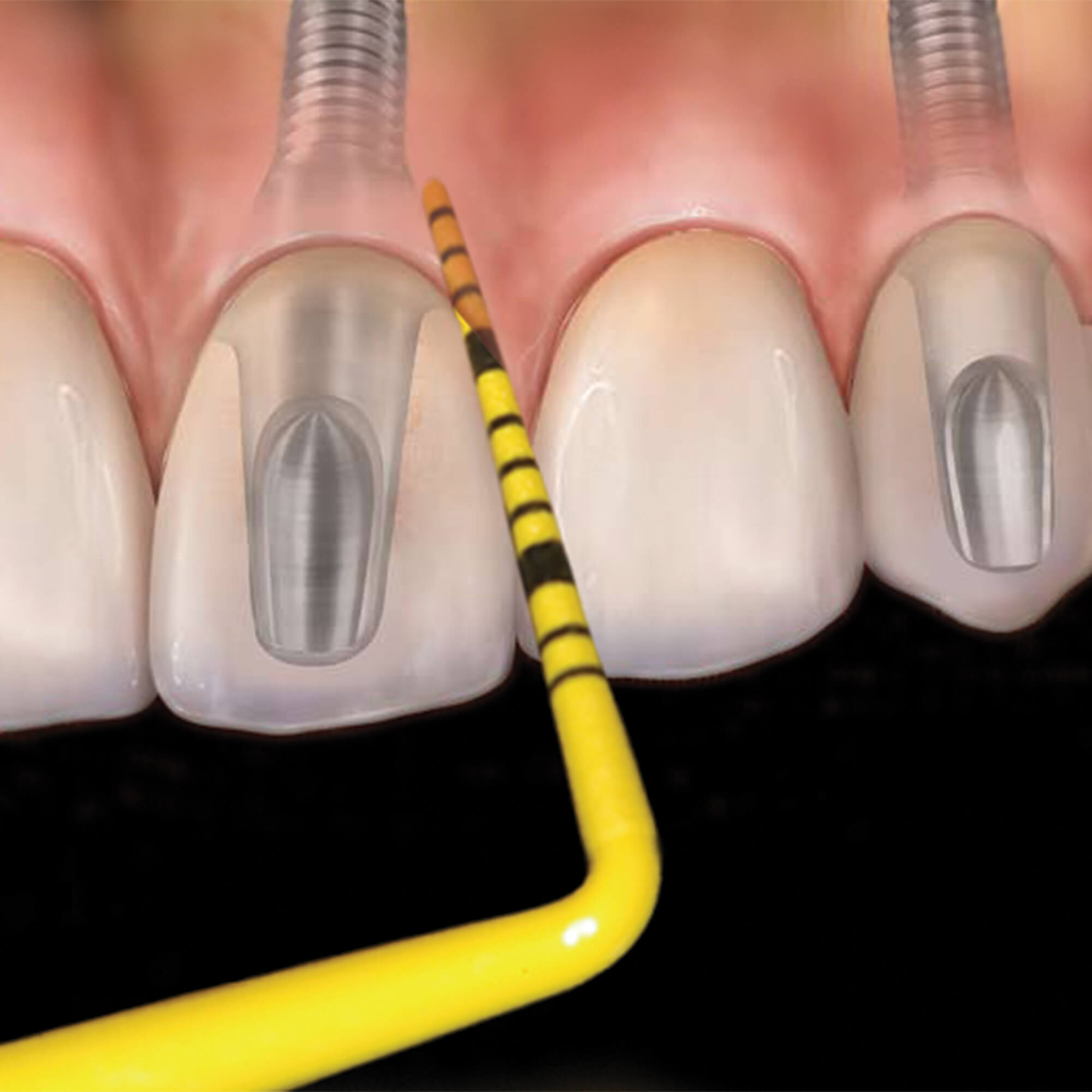 Colorvue Probe, Replacement Tips, # 12 University of North Carolina, 1-2-3-4-5-6-7-8-9-10-11-12, 12/Pk, PCVUNC12PT thumbnail 13