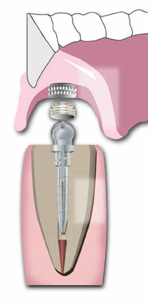 Sizes 1/2 Titanium Flexi-Overdenture Introductory Kit thumbnail 3