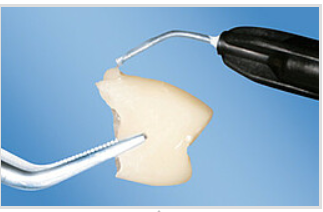 LuxaFlow Provisional Add-On Material, Syringe Refill, 1.5 g, A3, 2/Pk, 224003 thumbnail 15