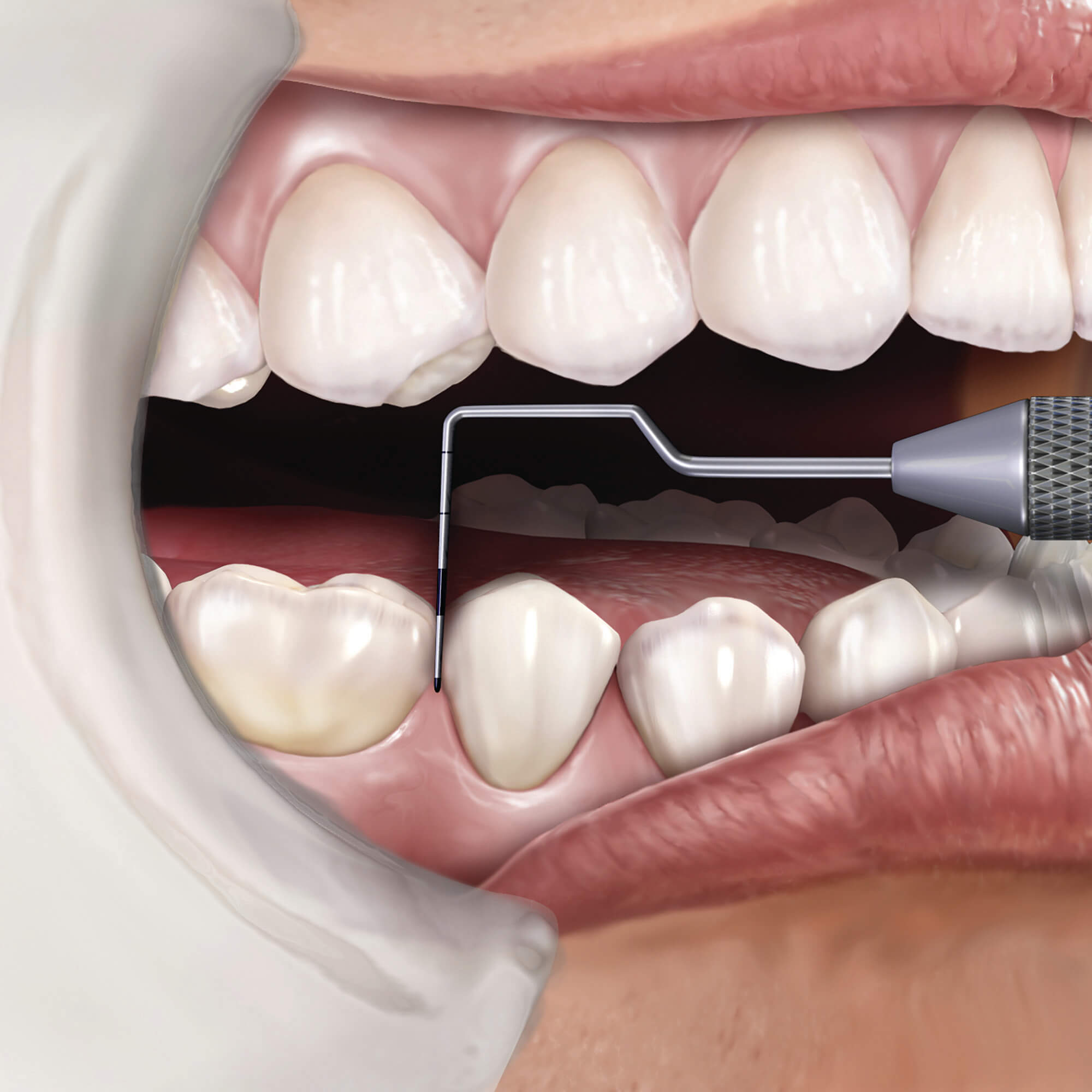 Probe Size 2 Single End Novatech Ea thumbnail 9