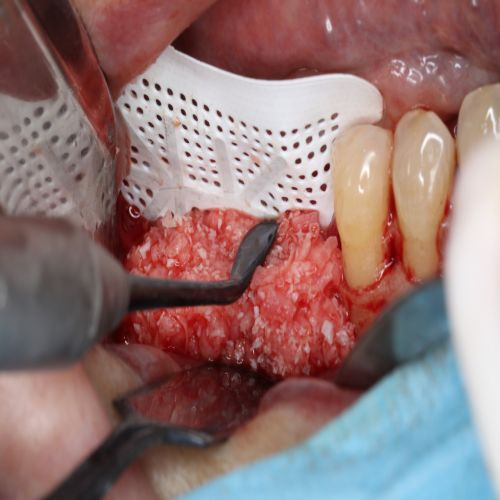 Composite Filling Instrument Size 1MK Woodson Ea thumbnail 18