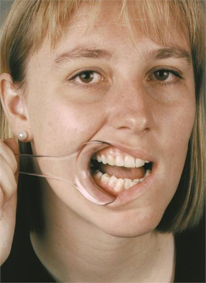 Mirahold Cheek Retractor, Child, 2/Pk, 605451 thumbnail 11