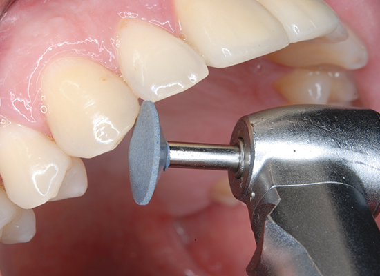 CeraMaster Polisher Assortment Kit Ea thumbnail 6