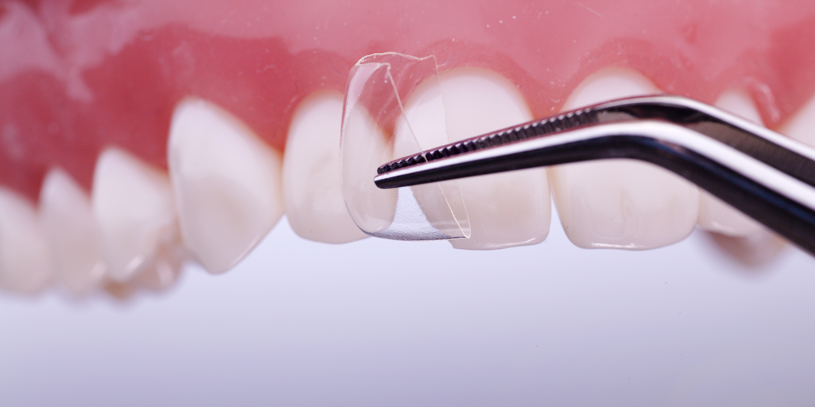 CoForm Crowns Size Assorted Mesial / Distal Complete Kit Ea thumbnail 3