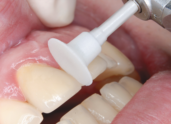 OneGloss PS Disposable Aluminum Oxide Silicon Polishers, CA, Refill, Inverted Cone, # 100, 50/Pk, 0178 thumbnail 23