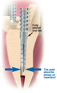 Red Size 1 Flexi-Post Titanium Standard Introductory Kit thumbnail 7