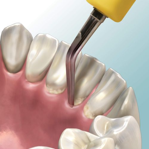 Streamline Ultrasonic Insert #3 Beavertail 25 kHz Ea thumbnail 8