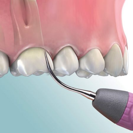 Universal Satin Swivel Ultrasonic Insert, Direct Flow, # 10, 30K, 1/Pk, UI30SD10 thumbnail 15